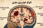انواع خونریزی مغزی و تفاوت آن‌ها با هم